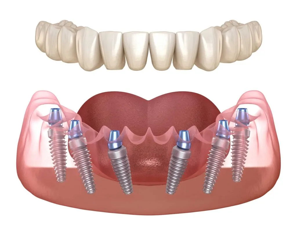 Carga inmediata de implantes dentales en Alcázar de San Juan: una nueva forma de recuperar tu sonrisa