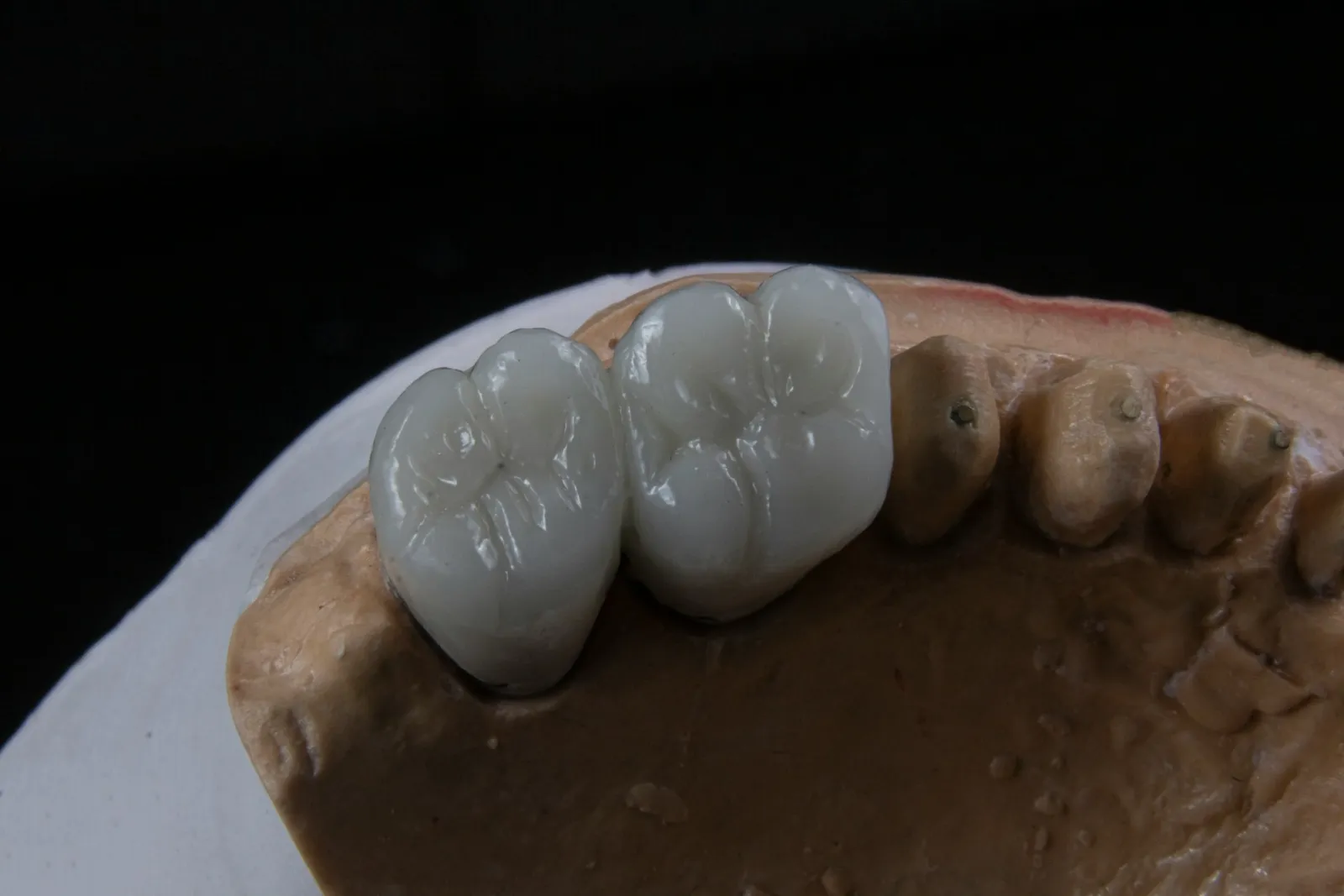 Carga inmediata: recupera tu sonrisa en un solo día