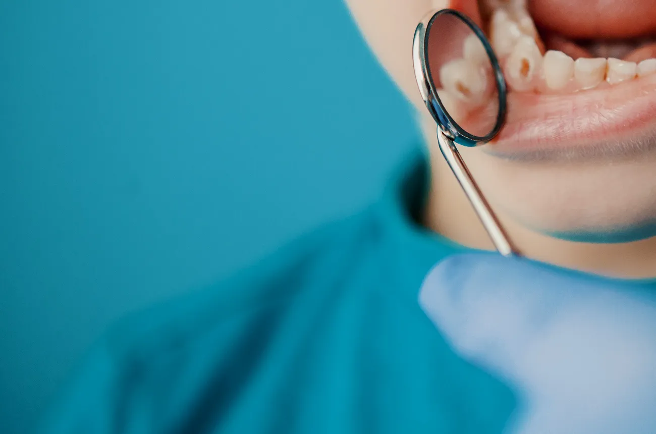 ¿Cómo evitar la caries dental?