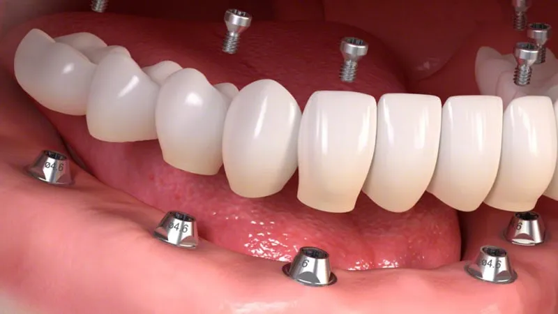 Implantes con carga inmediata