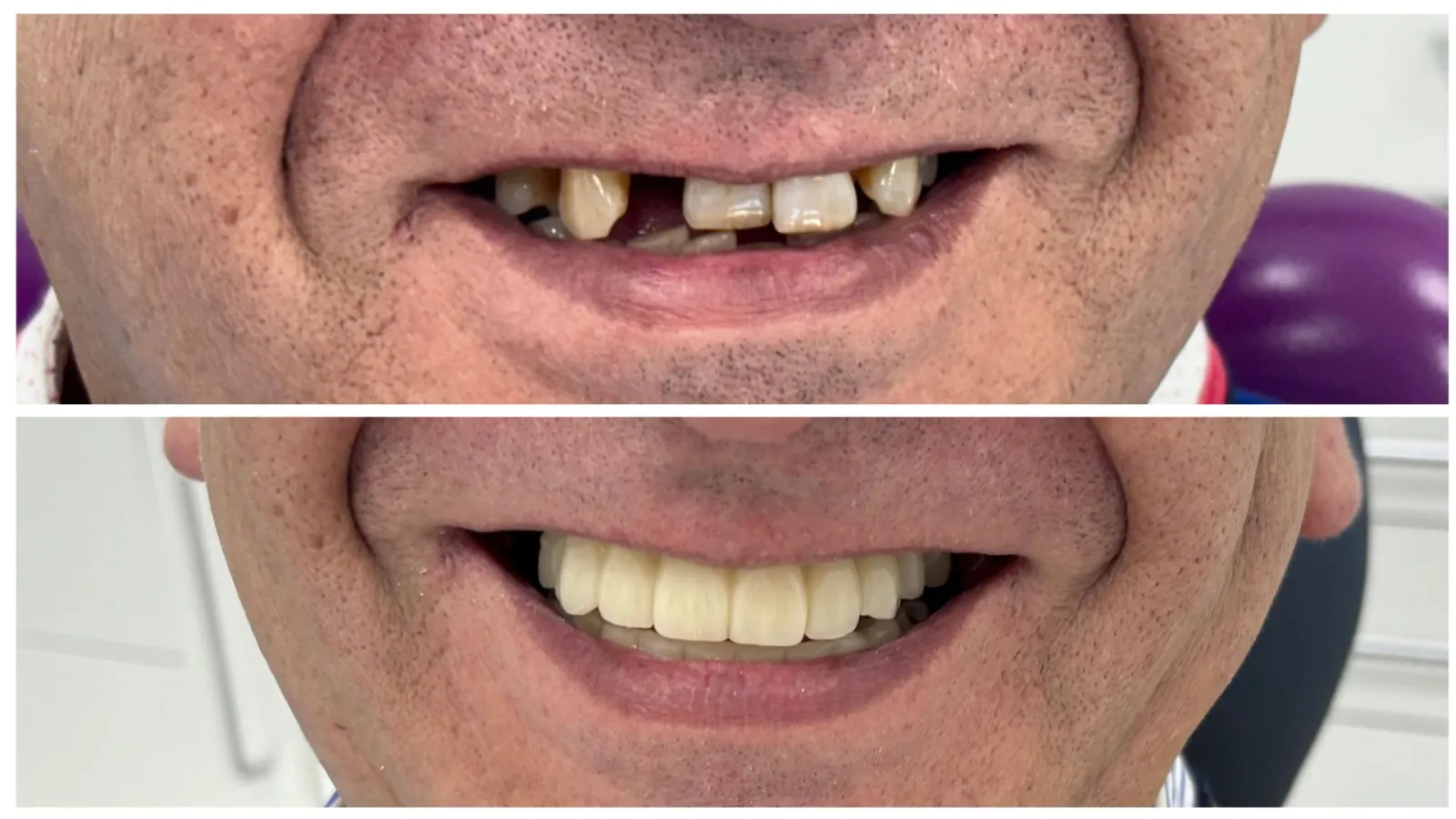 Dientes fijos en el día en Alcázar de San Juan: recupera tu sonrisa sin esperas