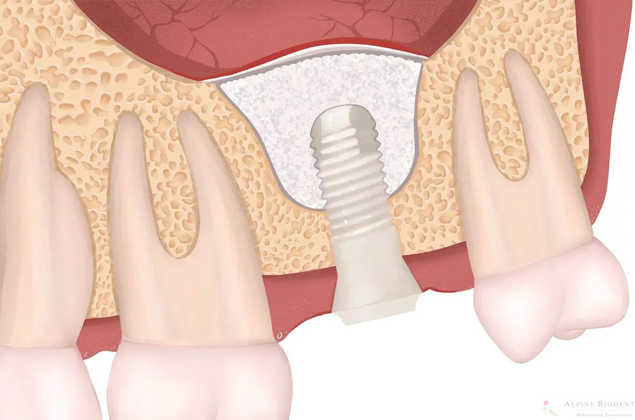 Elevación del seno maxilar: la clave para recuperar tu sonrisa con implantes dentales