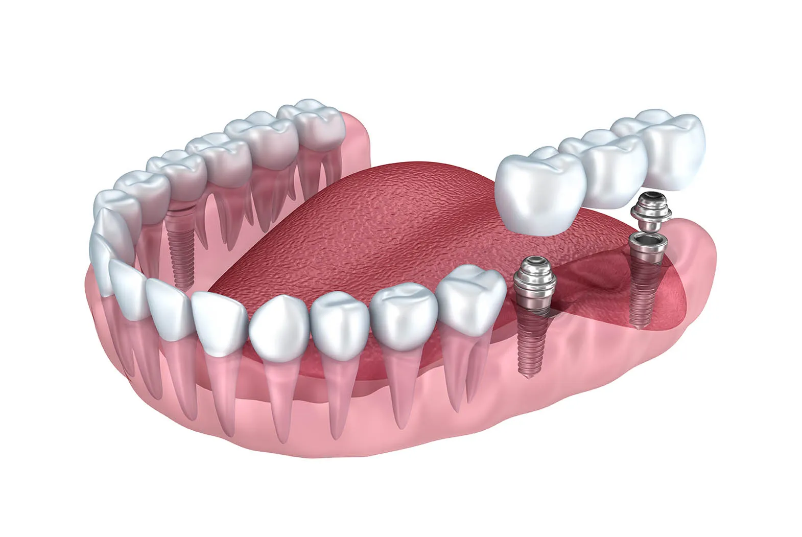 Especialista en implantes dentales en Collado Villalba