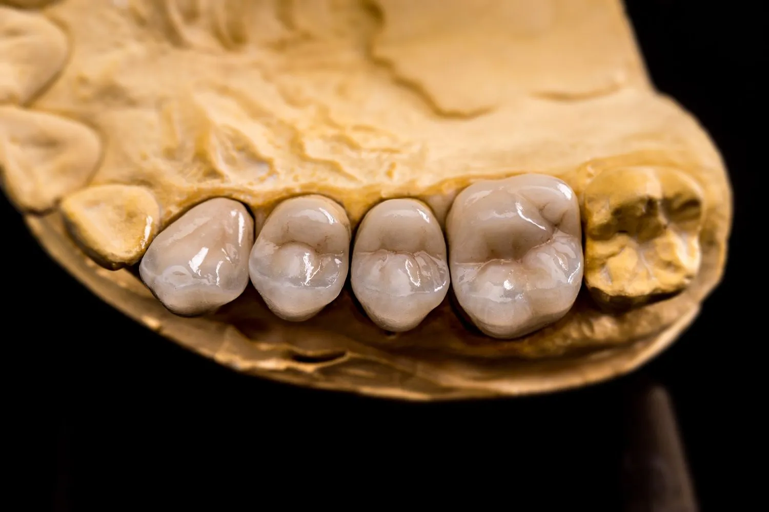 Implantes dentales en Madrid: recuperar tu sonrisa con seguridad, estética y tecnología avanzada