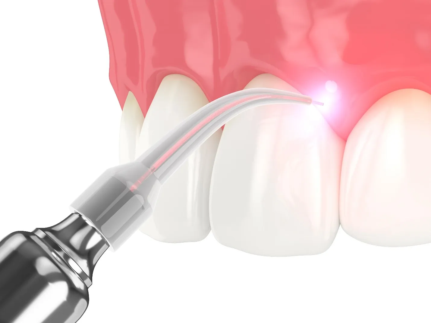 ¿Ir al dentista sin agujas, sin ruido y en muchos casos sin anestesia? El láser dental cambia por completo la experiencia del paciente