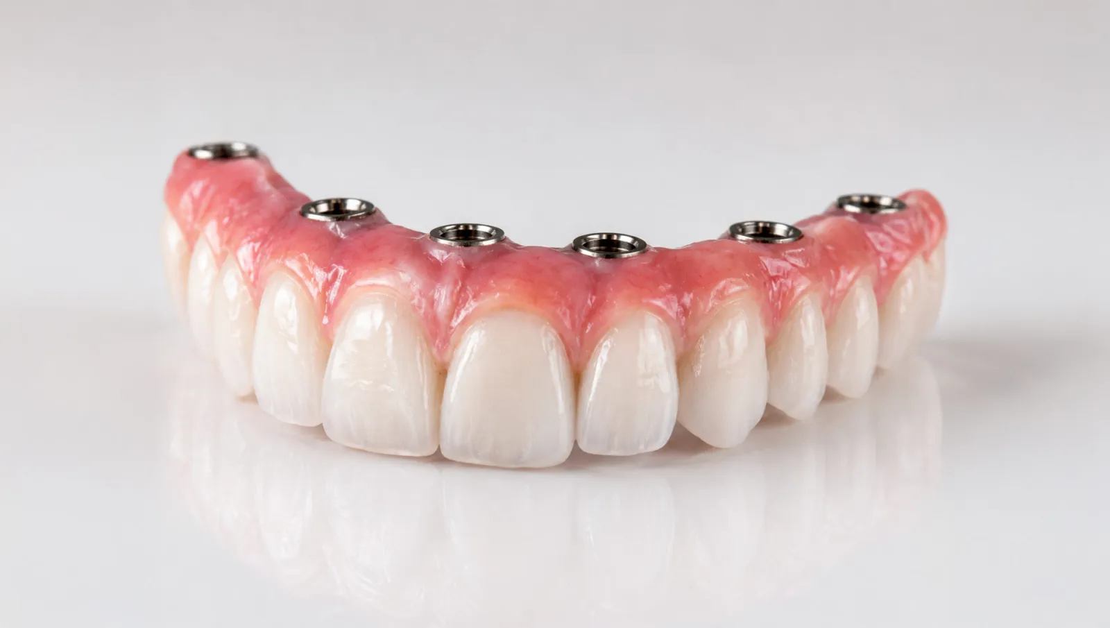 Prótesis fija sobre 6 implantes dentales: recupera tu sonrisa con una solución estable, estética y duradera